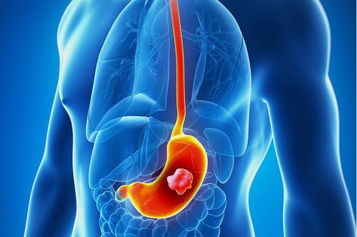 胃癌的中医治疗方法有哪些