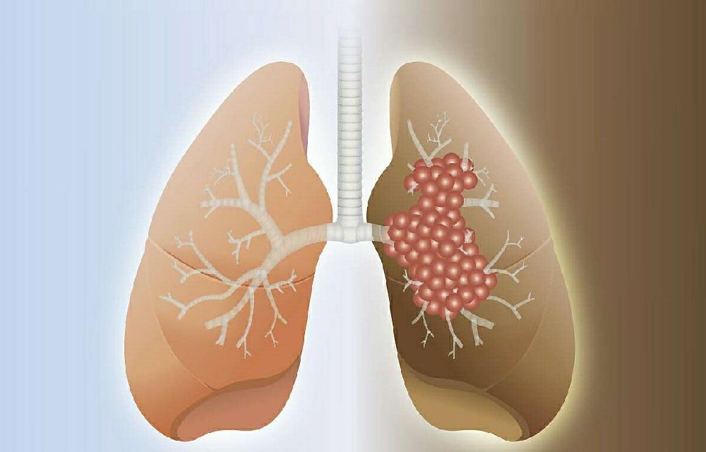杭州治疗肺癌的专家