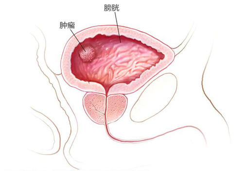 杭州御和堂中医：膀胱癌的临床知识有什么？