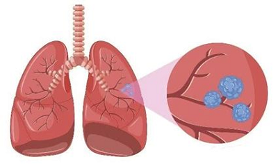 杭州御和堂中医：肺癌如何有效的预防