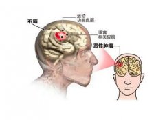 常见的脑转移症状有哪些？