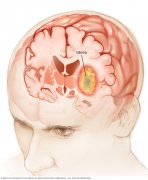 脑胶质瘤患者头痛的症状
