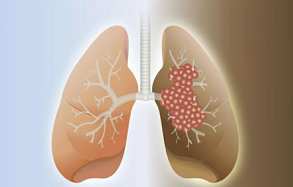 肺癌早期有哪些症状?