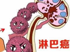 晚期淋巴癌的护理的时候应该注意什么？