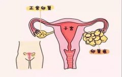 卵巢癌是怎么引起的?