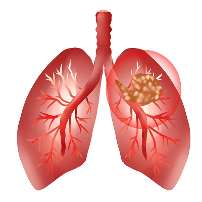 杭州御和堂中医:肺癌在早期的发病征兆有哪些?