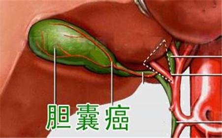 胆囊癌治疗方法