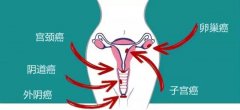 什么是外阴癌？外阴癌对女性有什么伤害？